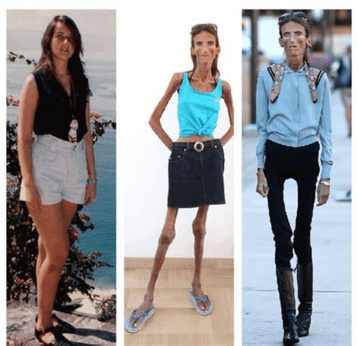 Exploring the Life of the World's Skinniest Person: A Journey Beyond Appearances